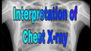 Basic Interpretation of Chest XRAY CXR  MisMedicine [upl. by Adlemi163]