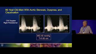 Severe Aortic Stenosis [upl. by Nawat721]