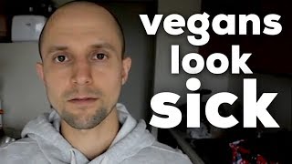 Why Do Vegans Look Sick  Vegans Are Malnourished [upl. by Kris]