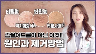 비립종 한관종 피지샘증식증 편평사마귀 좁쌀여드름이아니라고 원인부터 확실한 치료방법까지❗ [upl. by Goodrow]