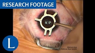 Surgical video Femtosecond LASIK procedure Video 1 of 2 [upl. by Rosenblast]