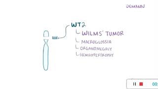 Wilms tumor or nephroblastoma [upl. by Mabelle649]