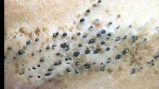 Extreme Blackheads  Oiliest Skin youll ever see [upl. by Carolynn]