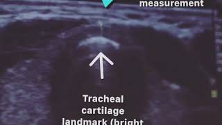 Thyroid ultrasound probe placement and measurements [upl. by Aianat]