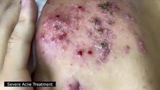 BEST BLACKHEAD AND WHITEHEAD REMOVAL SEVERE ACNE TREATMENT  SATISFYING AND RELAXING VIDEO [upl. by Gnen]