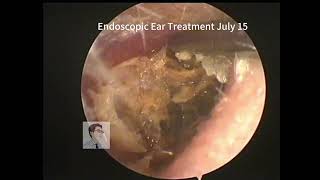 Completely blocked ear cleaning 20230715 [upl. by Burris]