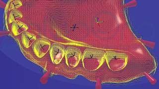 Full digital denture leading the way [upl. by Enaelem]