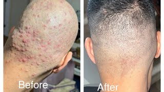 folliculitis treatment Scalp acne treatment  my problem SOLVED ￼ pls read description [upl. by Orelu]