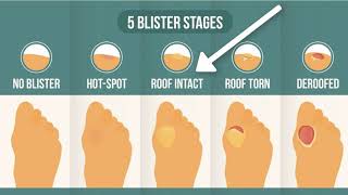 How To Treat A Blister Correctly First Look At Your Blister Roof [upl. by Nitin]