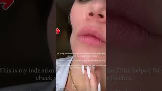 Khloé Kardashian shows off huge indentation on cheek after skin cancer removal shorts [upl. by Nerha631]