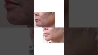 Lumecca IPL Your Radiant Skin Solution  HOW TO GET RID OF DARK SPOTS [upl. by Sana480]