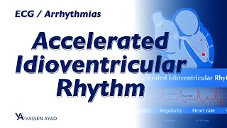 ECG 59  Accelerated Idioventricular Rhythm [upl. by Toms912]