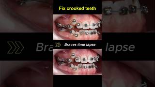 Braces for crooked teeth transformation before and after braces orthodontist dentist bracket [upl. by Annerb]