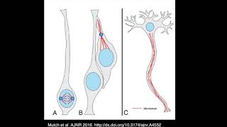 Tubulinopathies in 5 minutes [upl. by Nesyla]