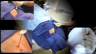 WATCH a Cervical Epidural Steroid Injection Demonstration  LIVE [upl. by Dorita]