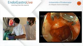 Hemostase endoscopique dun ulcère duodénal hémorragique [upl. by Ahseinar]