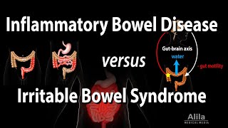 Inflammatory Bowel Disease vs Irritable Bowel Syndrome Animation [upl. by Hirsh]