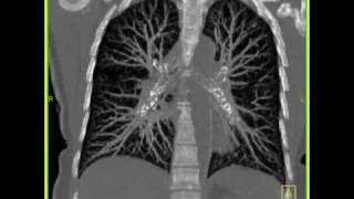 Lung Anatomy Normal Lung Vasculature [upl. by Trainer502]