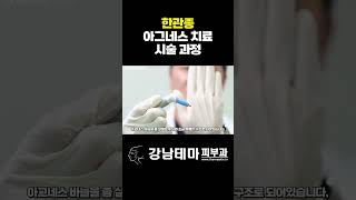 아그네스 한관종 치료 한관종아그네스 [upl. by Kreitman]