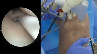 Meniscal Capsular Tears Ramp Lesions Feat Dr Kyle Borque [upl. by Obellia]