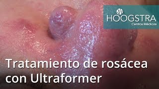 Tratamiento de rosácea con Ultraformer 17123 [upl. by Mcknight878]