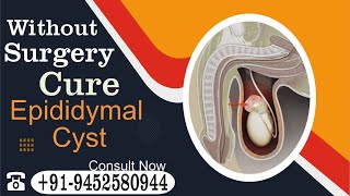 How do you get rid of an epididymal cyst naturally Know by Dr Nizamuddin Qasmi sir [upl. by Xanthe]