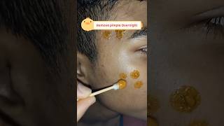 😌Remove pimple in overnight permanentlyOvernight Acne Treatment ytshorts viralvedios acneremoval [upl. by Edyak716]