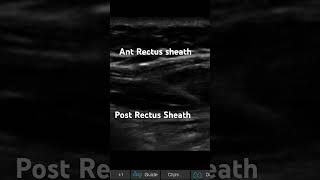 RECTUS SHEATH BLOCK IN LONG AXIS [upl. by Asecnarf]