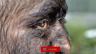 Hypertrichosis What is Werewolf Disease [upl. by Lisetta]