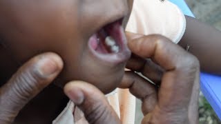 Dentist leaves 30 millimeter needle in child’s gum [upl. by Ecidnak]