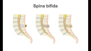 Managing spina bifida [upl. by Nal456]