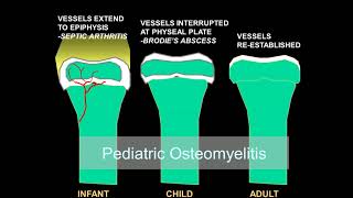 Imaging osteomyelitis acute and chronic [upl. by Bivins]