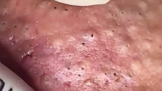 Blackheads amp Whiteheads Satisfying Removal 0275 [upl. by Roslyn323]