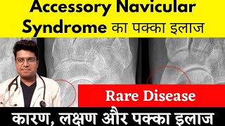 Accessory Navicular Syndrome के लक्षण और पक्का इलाज healwithdr [upl. by Everick]