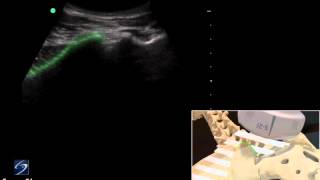 How To Ultrasound Guided Sacroiliac Injection  Sonosite Ultrasound 3D Video [upl. by Torto749]