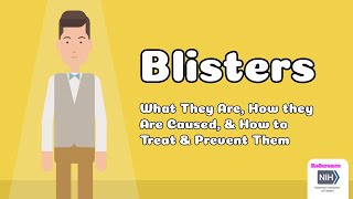 Blisters  What They Are How they Are Caused amp How to Treat amp Prevent Them [upl. by Alvie416]