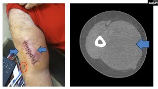 Unplanned Excision of Soft Tissue Sarcomas Juan Pretell MD [upl. by Einwahr291]