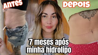 MINHA HIDROLIPO 7 MESES DEPOIS  OLHA COMO ESTÃ MINHA BARRIGA [upl. by Hansiain]