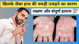 छिलके जैसा हाथ की चमड़ी उजड़ने का कारण लक्षण और इलाज  Peeling skin treatment in Hindi [upl. by Howes]