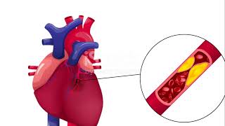 Cardiovascular disease Atherosclerosis [upl. by Yelsnya]