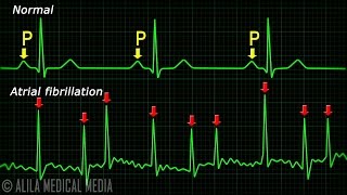 Atrial Fibrillation Anatomy ECG and Stroke Animation [upl. by Ahseim]