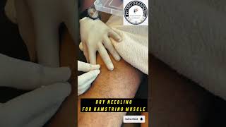 Dry needling for hamstring [upl. by Silvie]