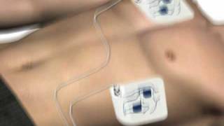 How to use an AED automated external defibrillator [upl. by Asiel]