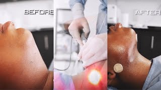 1 YEAR CHIN LIPO UPDATE  MY EXPERIENCE RECOVERY COST ETC [upl. by Euqinotna]