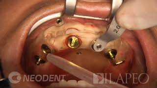 Vídeo 9 1 Cirurgia Guiada Neodent Digital [upl. by Blaseio]