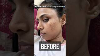 How to use Tretinoin Cream for most effective results Tretinoin before and after skin ✨shots [upl. by Etnovert]