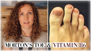 Big Toe Shorter than Second Toe Mortons Foot You Might Have Vitamin B6 Deficiency [upl. by Socher]