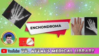 Enchondroma  Benign bone tumor [upl. by Anak106]