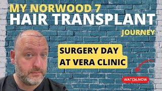 Matts Norwood 6 7 Hair Transplant Journey Vera Clinic Ep 2 Surgery Experience [upl. by Cock623]