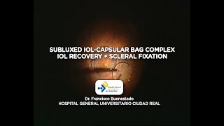 Subluxed IOLcapsular bag complex [upl. by Lledniw788]